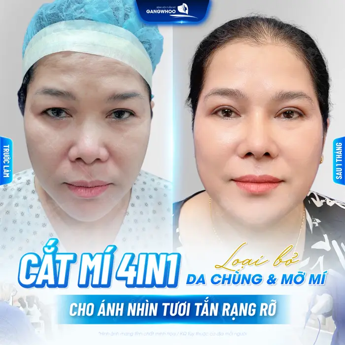 Cắt mí 4 In 1 loại bỏ da chùng và mỡ mí cho ánh nhìn tươi tắn đầy rạng rỡ