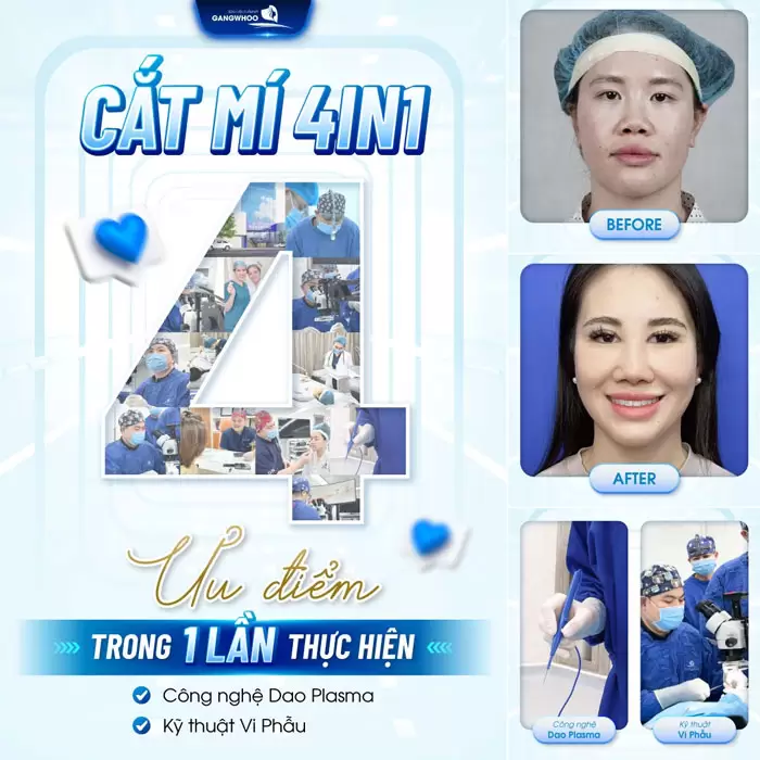 Cắt Mí 4 In 1 Plasma Khắc Phục Mọi Khuyết Điểm, Mắt 2 Mí Đẹp Hoàn Hảo 3 Cắt mí 4 In 1 mang lại nhiều ưu điểm vượt trội được nhiều người lựa chọn
