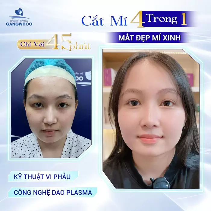 Mắt Phượng Hoàng Là Gì? Tướng Số Có Tốt Không? 15 Mí mắt xinh đẹp sau 45 phút cắt mí áp dụng công nghệ cao