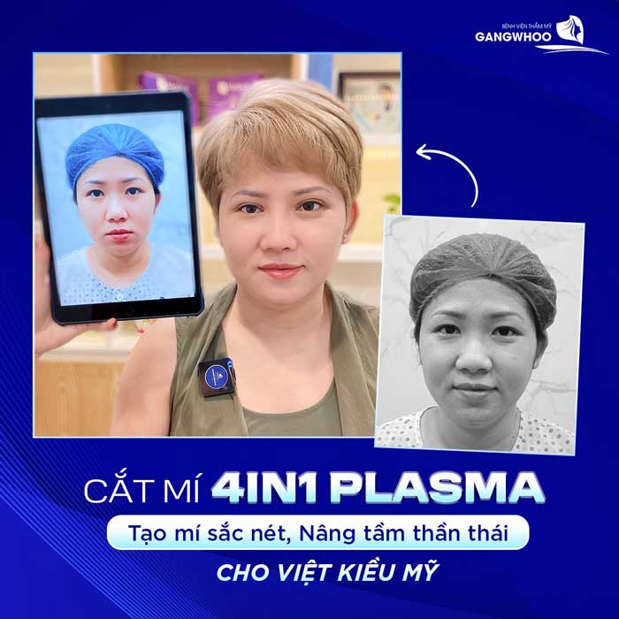Nhiều khách hàng Việt Kiều về Việt Nam thực hiện cắt mí mắt