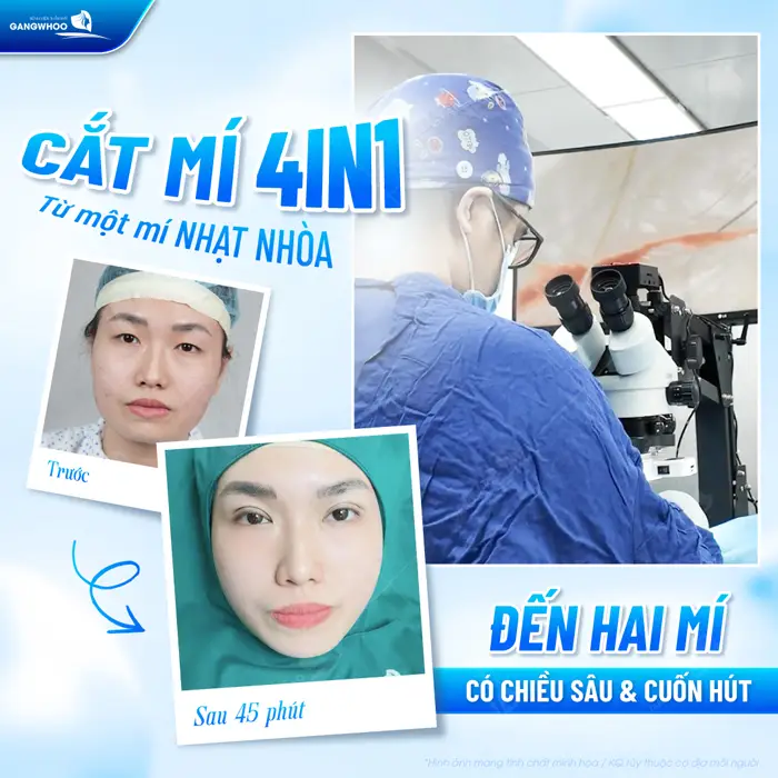 Cắt mí 4 In 1 từ mắt nhạt nhòa đến mắt 2 mí có chiều sâu đầy cuốn hút