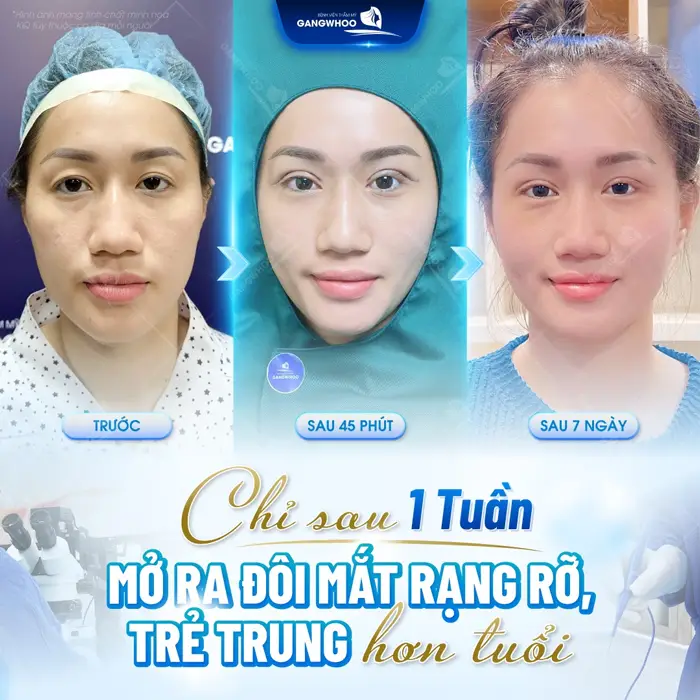 Cắt Mí 4 In 1 Plasma Khắc Phục Mọi Khuyết Điểm, Mắt 2 Mí Đẹp Hoàn Hảo 4 Chỉ sau 1 tuần mở ra đôi mắt rạng rỡ đôi mắt trẻ trung hơn tuổi thật