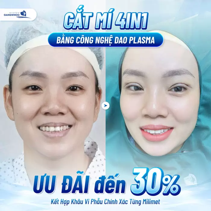 Cắt Mí 4 In 1 Plasma Khắc Phục Mọi Khuyết Điểm, Mắt 2 Mí Đẹp Hoàn Hảo 6 Cắt mí 4 In 1 Plasma bằng công nghệ dao Plasma mắt đẹp chuẩn xác trong từng milimet