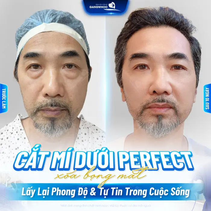 Cắt mí dưới Perfect xóa bọng mắt lấy lại phong độ và sự tự tin trong cuộc sống
