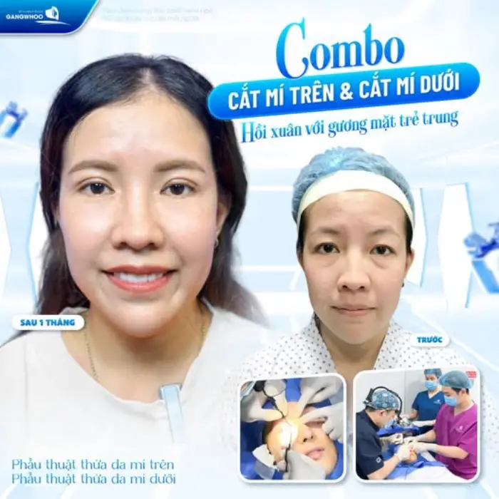 Phẫu thuật thẩm mỹ mắt toàn diện định hình nếp mí trên hài hòa kết hợp làm phẳng vùng mí dưới