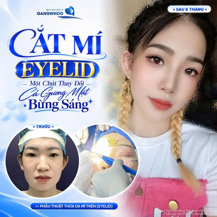 Phẫu Thuật Thừa Da Mi Trên (Cắt Mí Eyelid) Cho Mắt 2 Mí Đẹp Tự Nhiên 3 Cắt mí Eyelid 1 chút thay đổi nhỏ cho gương mặt thêm bừng sáng và thêm cuốn hút