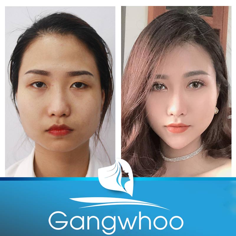 Images of our customers before & after blepharoplasty at Gangwhoo Cosmetic Hospital