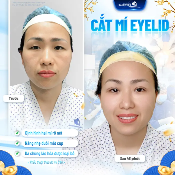Cắt mí Eyelid định hình lại nếp mí đẹp rõ nâng nhẹ đuôi mắt và cải thiện ánh nhìn hiệu quả
