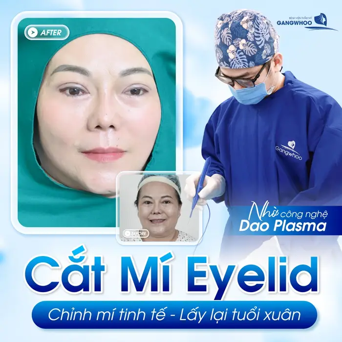 Cắt mí Eyelid bí quyết cho đôi mắt 2 mí đẹp tinh tế và hài hòa