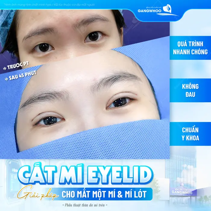 Cắt mí Eyelid giải pháp hoàn hảo cho đôi mắt 1 mí và mí lót sau ngay 45 phút thực hiện đã thấy nếp mí đều đẹp hơn hẳn