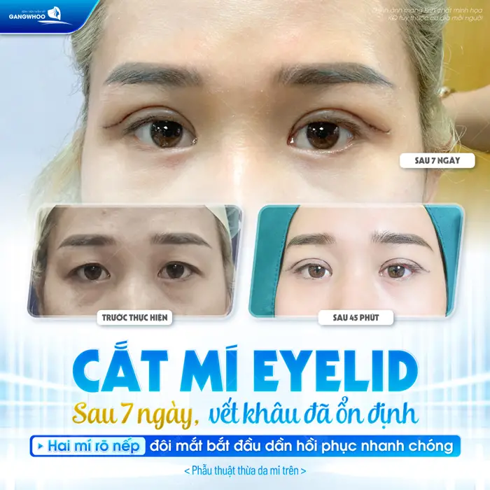Cắt mí Eyelid sau 7 ngày vết khâu đã ổn định vào phục hồi nhanh chóng thấy rõ