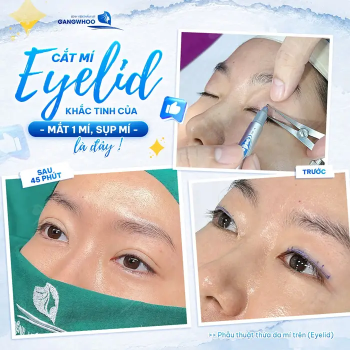 Cắt mí Eyelid khắc tinh của tình trạng mắt 1 mí, sụp mí hiệu quả cải thiện rõ rệt sau 45 phút