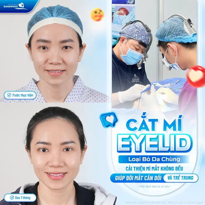 Cắt mí Eyelid loại bỏ da chùng cải thiện mí mắt không đều giúp đôi mắt cân đối và trẻ trung hơn 