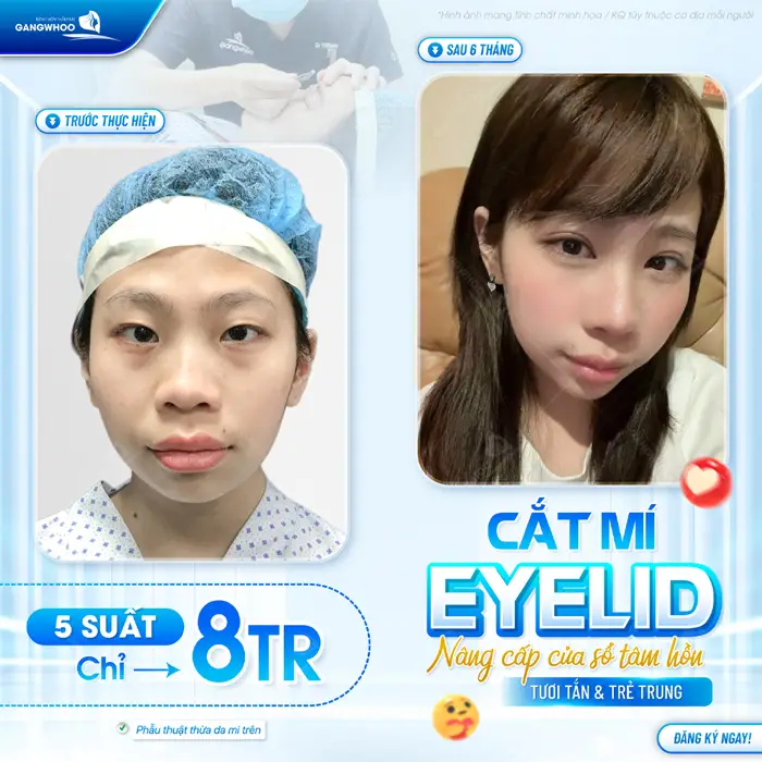 Cắt mí Eyelid nâng cấp cửa sổ tâm hồn thêm tươi tắn và trẻ trung với ưu đãi hấp dẫn tại BVTM Gangwhoo