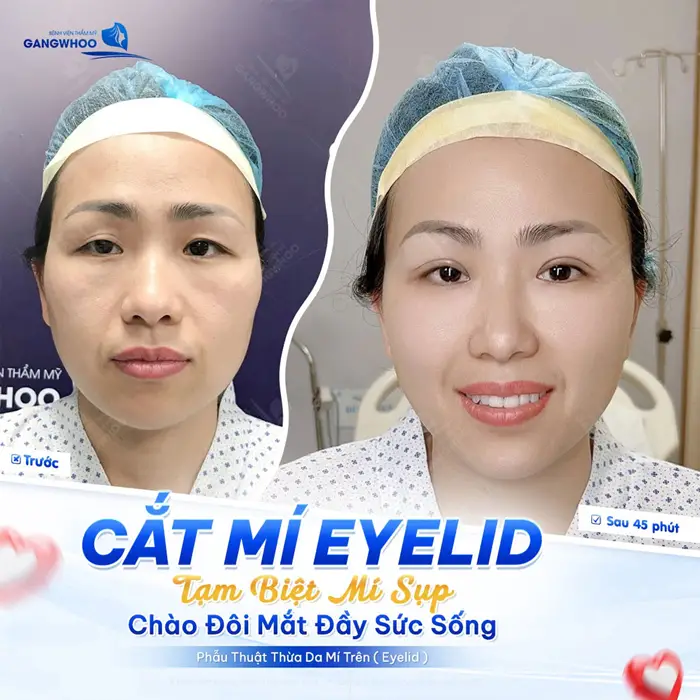 Phẫu Thuật Thừa Da Mi Trên (Cắt Mí Eyelid) Cho Mắt 2 Mí Đẹp Tự Nhiên 1 Cắt mí Eyelid tạm biệt mí sụp chào đôi mắt căng đẹp đầy sức sống