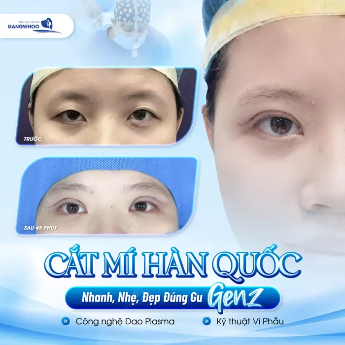 Cắt Mí Hàn Quốc Cho Bạn Đôi Mắt 2 Mí Đẹp Chuẩn "Sao Hàn" 5 Cắt mí Hàn Quốc lựa chọn hoàn hảo cho ánh mắt đẹp chuẩn gu và nhanh hồi phục