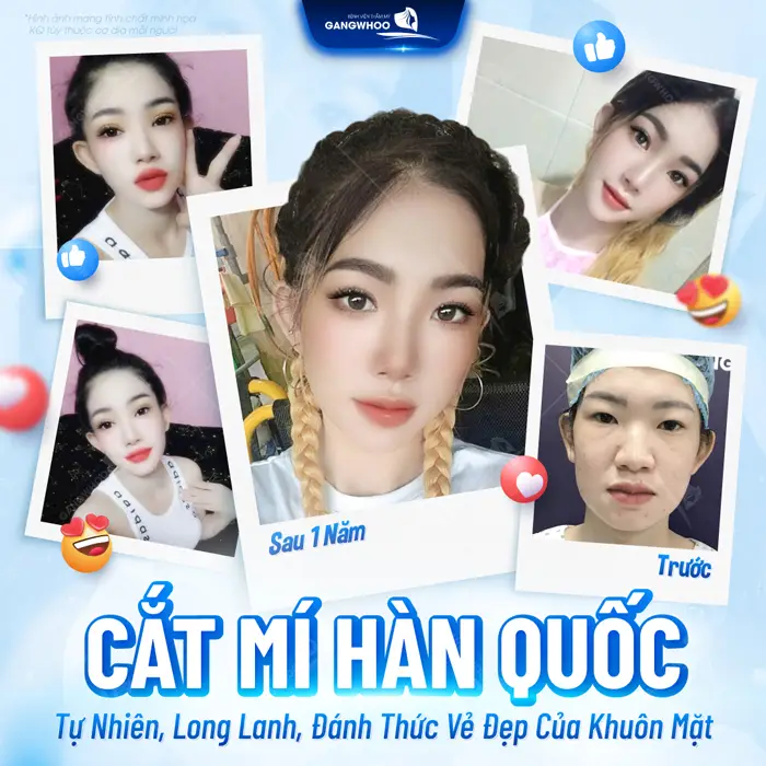 Cắt Mí Hàn Quốc Cho Bạn Đôi Mắt 2 Mí Đẹp Chuẩn "Sao Hàn" 3 Cắt mí Hàn Quốc sở hữu diện mạo xinh đẹp, long lanh và tràn đầy tự tin sau 1 năm thực hiện