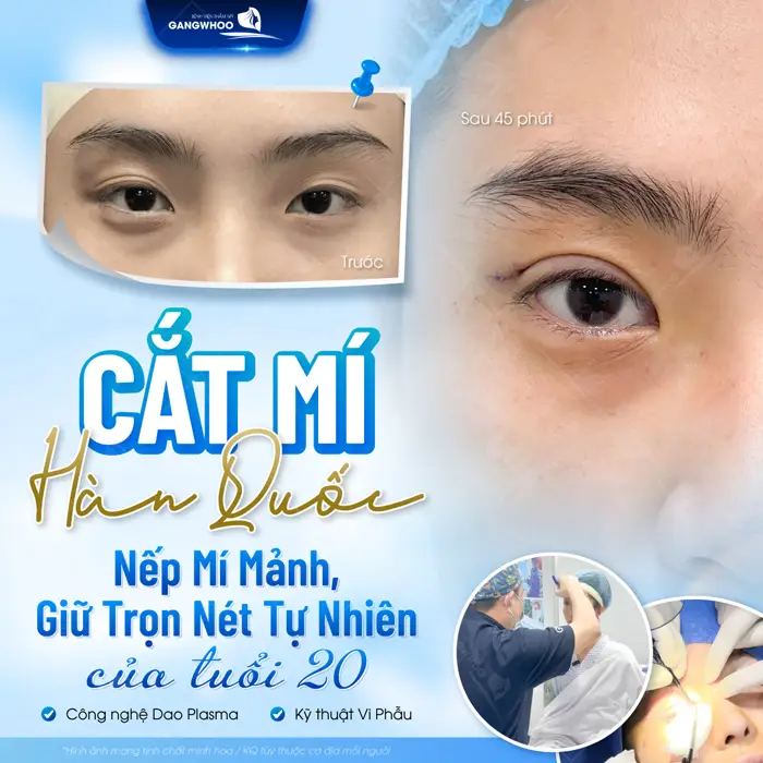 Cắt Mí Hàn Quốc Cho Bạn Đôi Mắt 2 Mí Đẹp Chuẩn "Sao Hàn" 2 Cắt mí Hàn Quốc nếp mí mảnh giữ trọn nét tự nhiên của tuổi 20