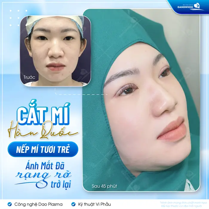 Cắt Mí Hàn Quốc Cho Bạn Đôi Mắt 2 Mí Đẹp Chuẩn "Sao Hàn" 1 Cắt mí Hàn Quốc nếp mí tươi trẻ ánh mắt rạng rỡ trở lại