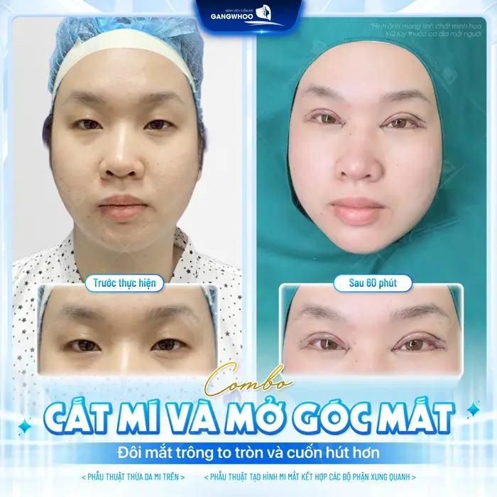 Combo cắt mí và mở rộng góc mắt đôi mắt trở nên to tròn và cuốn hút hơn sau 60 phút thực hiện đã hoàn toàn khác biệt