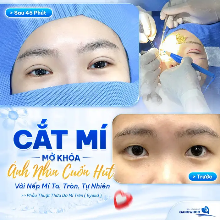 Cắt mí mở khóa ánh nhìn thêm cuốn hút với nếp mí to, tròn, đẹp tự nhiên