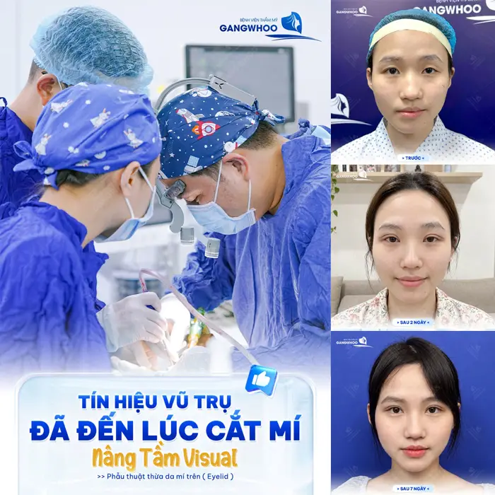 Cắt mí nâng tầm Visual nếp mí mềm mại, đường nét đẹp xinh diện mạo thêm thăng hạng và cuốn hút