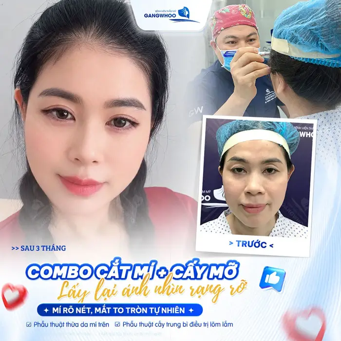 Combo cắt mí và cấy mỡ lấy lại ánh nhìn đầy rạng rỡ nếp mí đẹp rõ nét, mắt thêm to tròn và đẹp tự nhiên