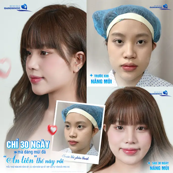 Chỉ 30 ngày mà dáng mũi đã đẹp chuẩn mềm mại và tự nhiên đẹp xuất sắc