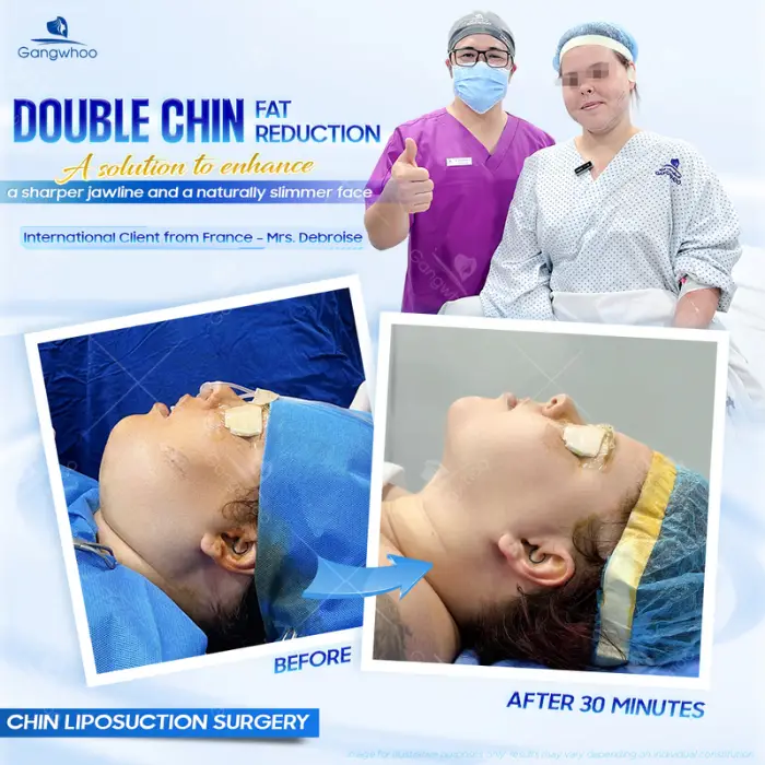 chin liposuction 2