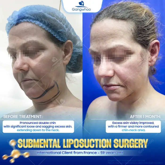 chin liposuction 3