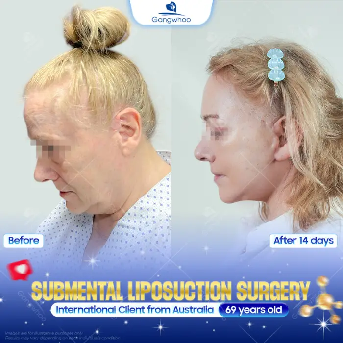 chin liposuction 4