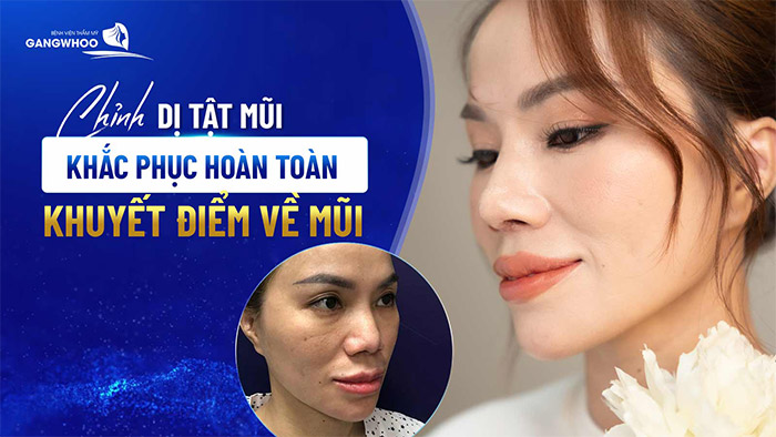 Chỉnh Dị Tật Mũi Khắc Phục Hoàn Toàn Khuyết Điểm Về Mũi 23 Chỉnh Dị Tật Mũi