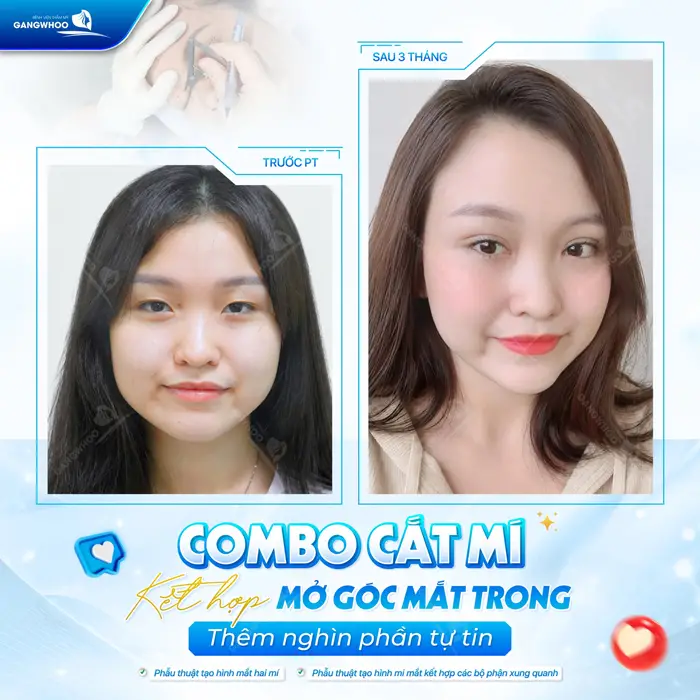 Combo cắt mí kết hợp mở góc mắt trong thêm nghìn phần tự tin 