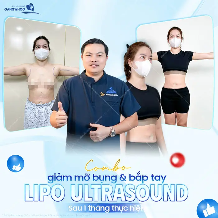 Combo giảm mỡ bụng và bắp tay (Lipo Ultrasound) sau 1 tháng thực hiện vào form đẹp xuất sắc