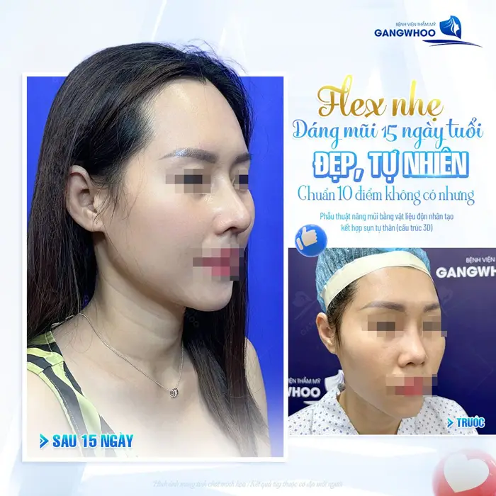 Flex dáng mũi nhẹ sau 15 ngày đã đẹp mềm mại, tự nhiên và đẹp chuẩn thần thái