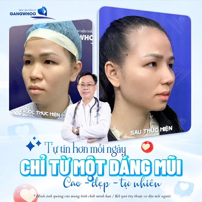 Thay đổi nhẹ nhàng dáng mũi diện mạo xinh đẹp tự tin hơn mỗi ngày 