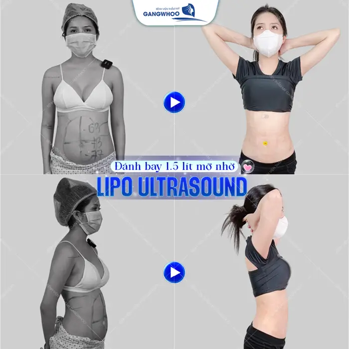 Lipo Ultrasound: Công Nghệ Hút Mỡ Được Nhiều Khách Quốc Tế Lựa Chọn 37 danh bay gan 2 lit mo thua