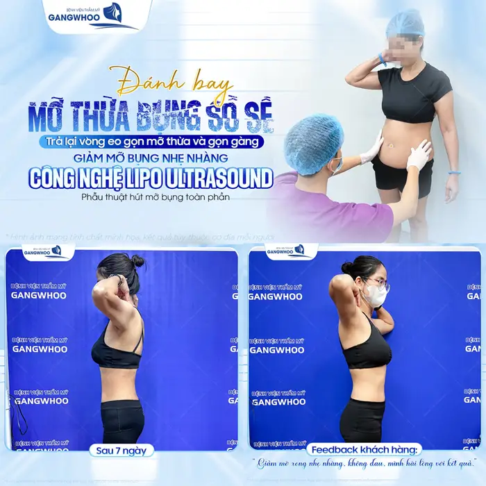 Đánh bay mỡ thừa bụng sồ sề trả lại vòng eo gọn mỡ thừa và gọn gàng sau giảm mỡ Lipo Ultrasound
