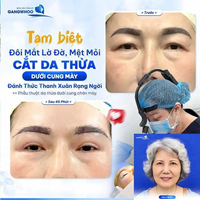 Phẫu Thuật Treo Cung Mày Trực Tiếp Nội Soi (Nâng Cung Chân Mày) Thổi Bay Dấu Hiệu "Lão Hóa" 5 Tạm biệt đôi mắt lờ đờ mệt mỏi sau thực hiện cắt da thừa qua đường chân mày