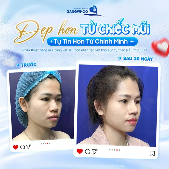 Đẹp hơn từng chiếc mũi tự tin hơn từ chính mình sau 30 ngày nhan sắc đẹp thăng hạng