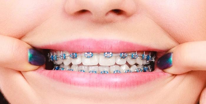 Dental braces service