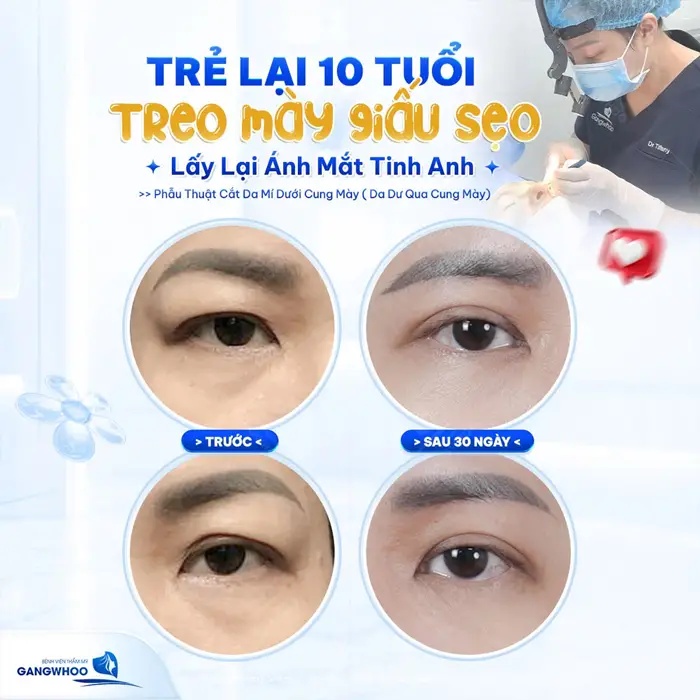 Phẫu Thuật Treo Cung Mày Trực Tiếp Nội Soi (Nâng Cung Chân Mày) Thổi Bay Dấu Hiệu "Lão Hóa" 7 Trẻ lại 10 tuổi treo cung chân mày giấu sẹo lấy lại ánh mắt tinh anh cho diện mạo