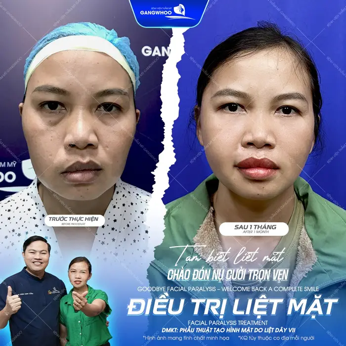 Tạm biệt liệt mặt sau 1 tháng nụ cười đã cân đối hài hòa và trọn vẹn trở lại 