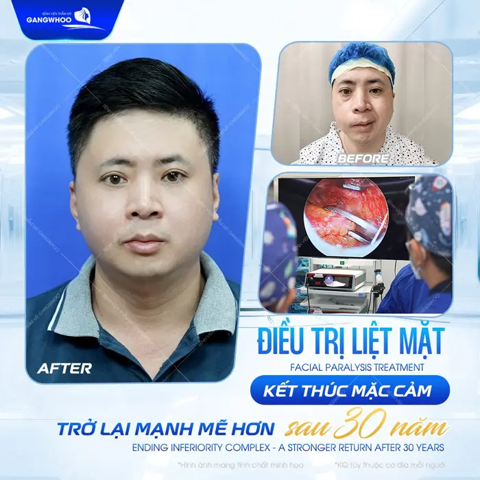 Điều Trị Liệt Mặt Nội Soi 4K - Lấy Lại Nụ Cười Trên Gương Mặt 3 Điều trị liệt mặt kết thúc mặc cảm sau 30 năm sống trong gương mặt méo xệch