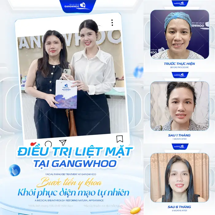 Điều Trị Liệt Mặt Nội Soi 4K - Lấy Lại Nụ Cười Trên Gương Mặt 1 Điều trị liệt mặt tại Gangwhoo an toàn chuẩn y khoa giúp khôi phục diện mạo đầy tự tin