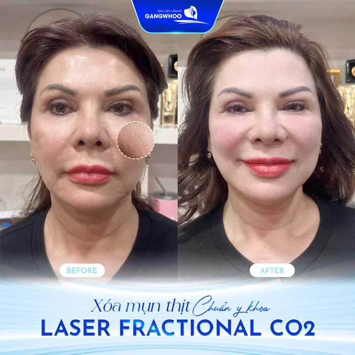 Điều Trị Mụn Thịt Tận Gốc Với Công Nghệ Hàn Quốc 12 điều trị mụn thịt