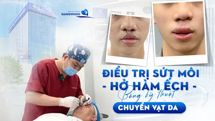 Điều Trị Sứt Môi Hở Hàm Ếch Bằng Kỹ Thuật Chuyển Vạt Da AB 19 Điều Trị Sứt Môi Hở Hàm Ếch Bằng Kỹ Thuật Chuyển Vạt Da