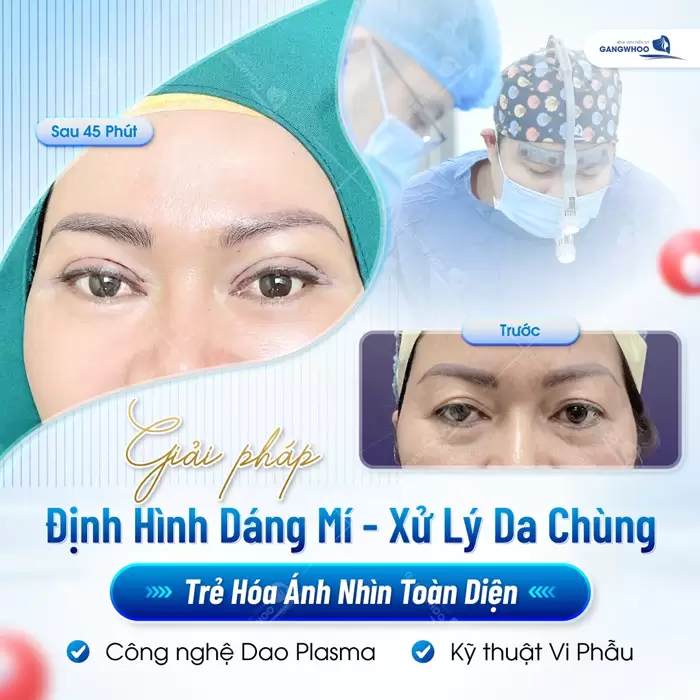 Công Nghệ Cắt Da Thừa Mí Dưới Và Lấy Mỡ Giúp Khuôn Mặt Đẹp Thanh Tú 1 Tạo hình dáng mí và xử lý da chùng mí dưới bí quyết trẻ hóa ánh nhìn một cách toàn diện