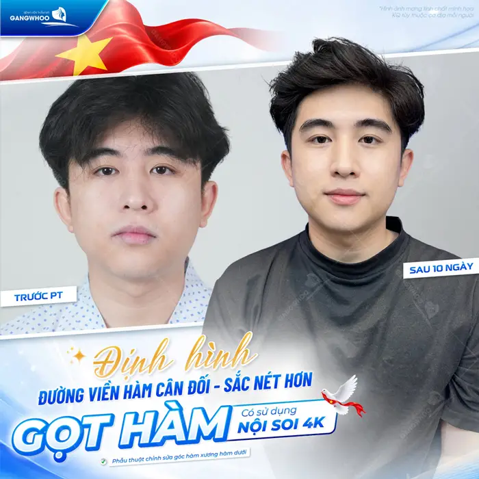 Định hình đường viền hằm cân đối và sắc nét hơn sau gọt hàm có sử dụng nội soi 4K