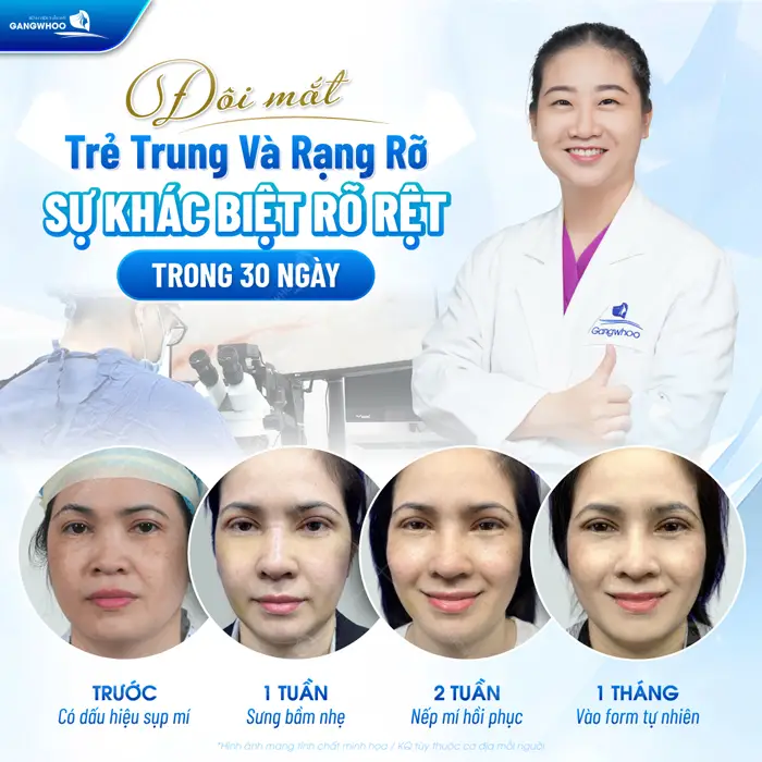 Cắt Mí 4 In 1 Plasma Khắc Phục Mọi Khuyết Điểm, Mắt 2 Mí Đẹp Hoàn Hảo 1 Đôi mắt trẻ trung và rạng rỡ thấy rõ sự khác biệt trong 30 ngày thực hiện